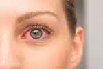 Les maladies oculaires liées au soleil