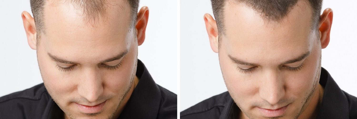 3 méthodes efficaces pour favoriser la repousse des cheveux