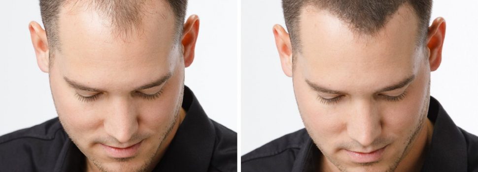 3 méthodes efficaces pour favoriser la repousse des cheveux